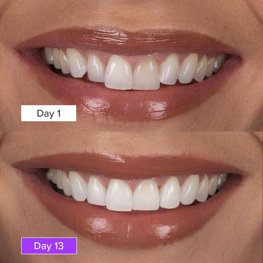 Aclaramiento dental casero
