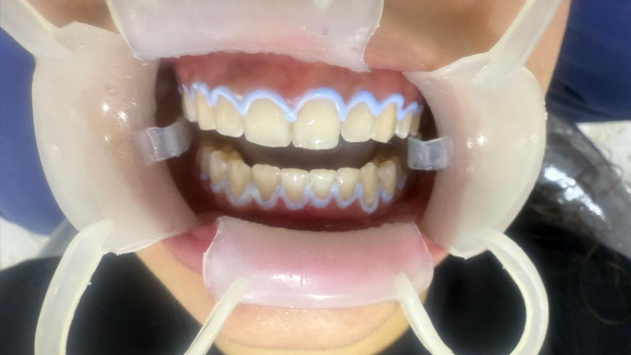 blanqueamiento dental en consultorio cali