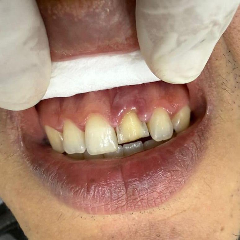 carilla en disilicato para diseño de sonrisa