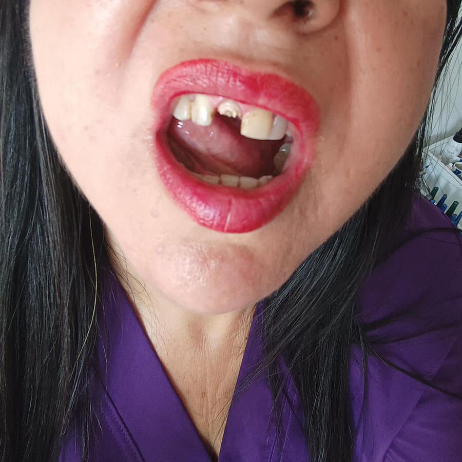 antes de una corona de zirconio en cali
