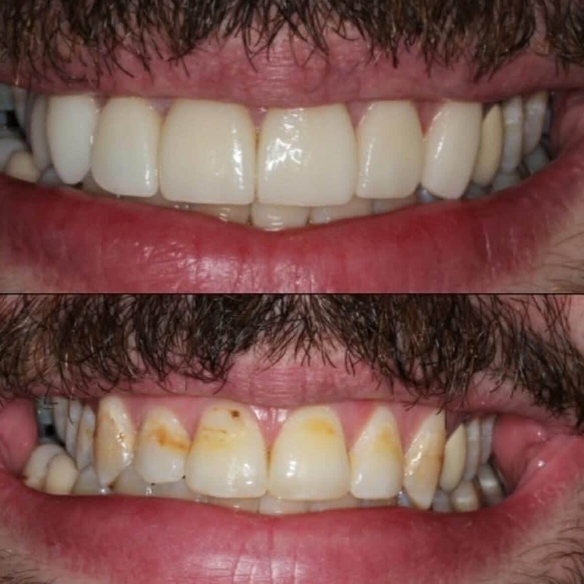 Mantenimiento de diseño de sonrisa en cali