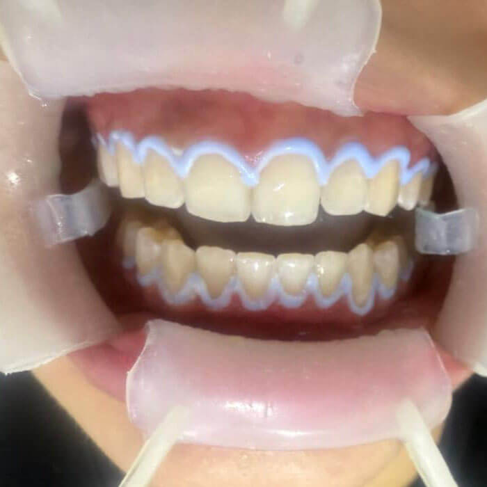 costo blanqueamiento dental  en cali