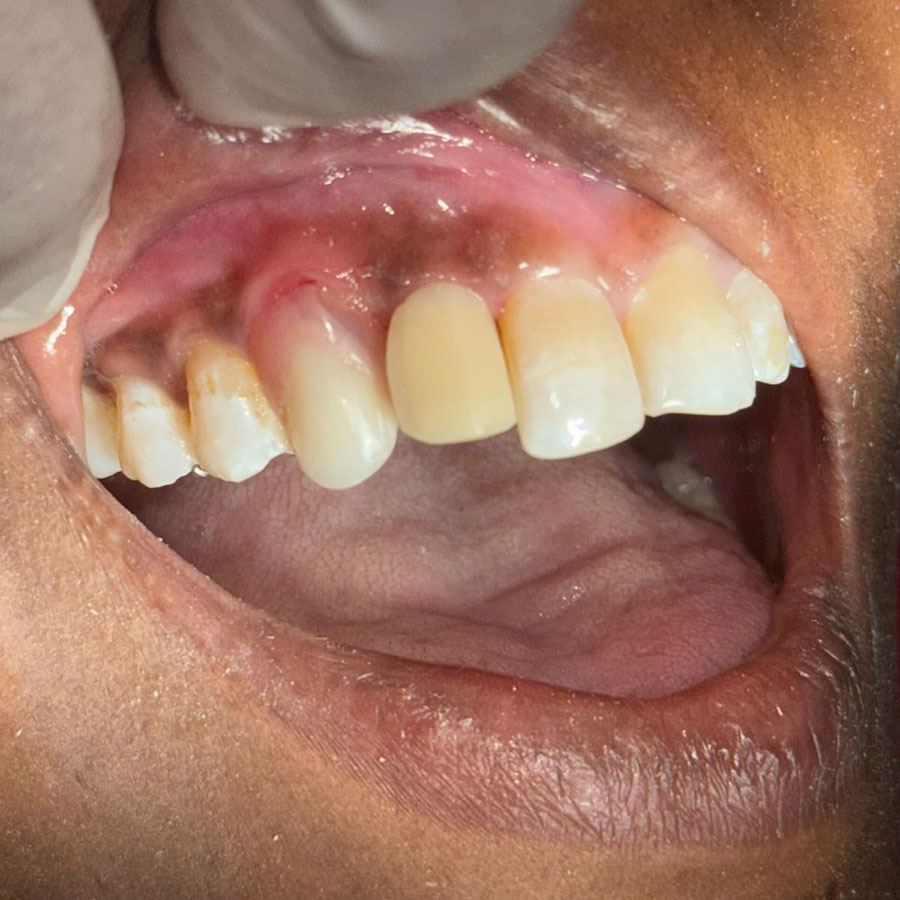 Microdiseño de sonrisa precio